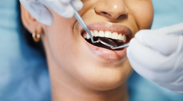 Best Emergency Wisdom Teeth Removal in Hamilton, OH